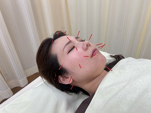 美容鍼灸イメージ