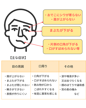 顔面神経麻痺