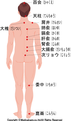 百会、天柱、大椎、肩井、肺兪、隔兪、肝兪、腎兪、大腸兪、次りょう、委中、崑崙