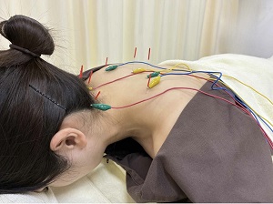 肩こり鍼灸イメージ