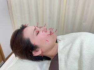 鍼灸治療について